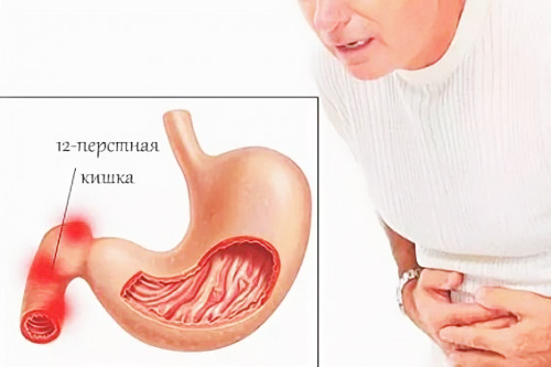 Язва двенадцатиперстной кишки: причины, симптомы, современная диагностика и эффективное лечение